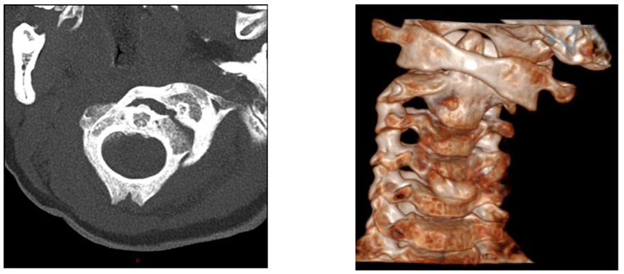 MRI findings of our first patient. MRI depicts the anterior displacement of anterior C1 facet relative to C2, indicating rotatory subluxation. Bone marrow and neck musculature signals were normal.