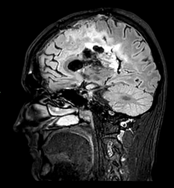 Post-operative Sagittal view of tumour (FLAIR))