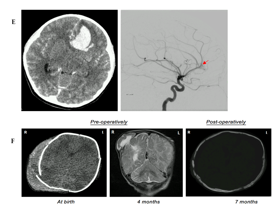 Neurologist and Neurosurgeon: A ‘Sine Qua Non’ in Paediatric Intracranial Pathology Management